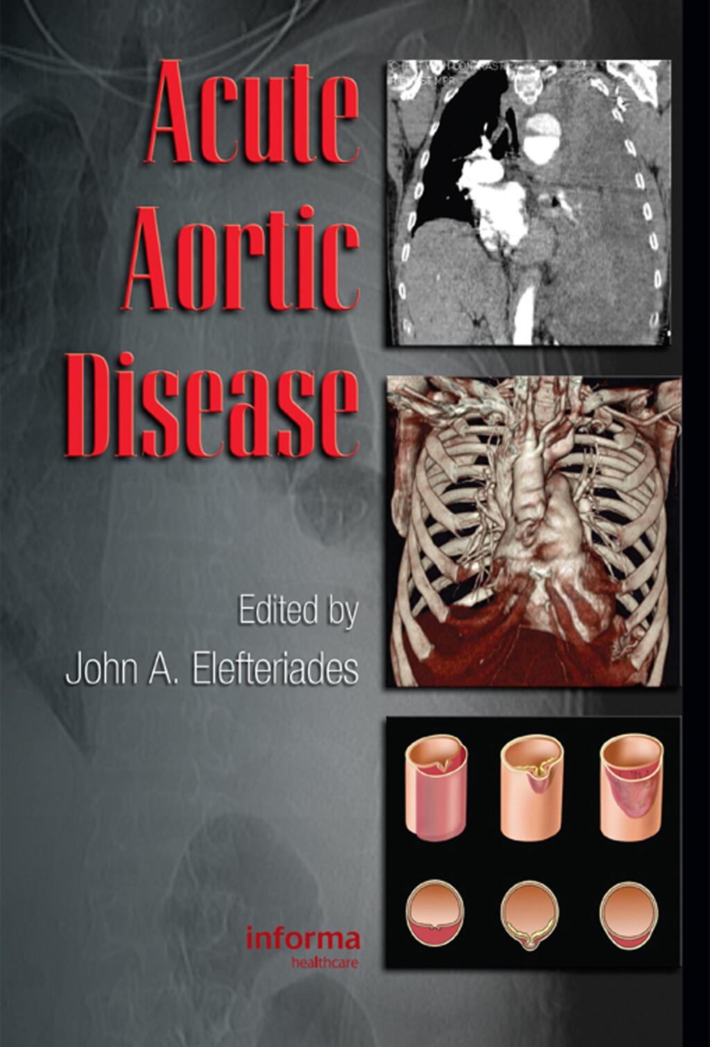 Acute aortic disease